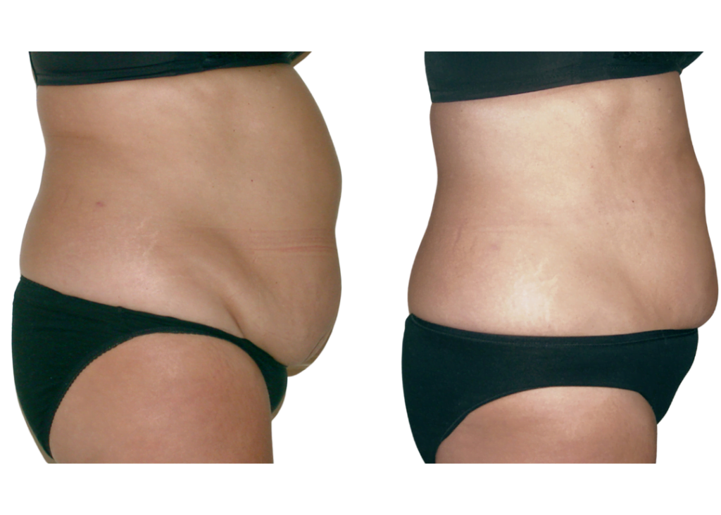 Laser Lipo - Maya Beauty Clinic